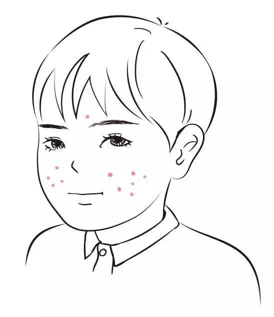 痘医生介绍痘痘如何分级治疗, 痘友应该掌握的祛痘知识