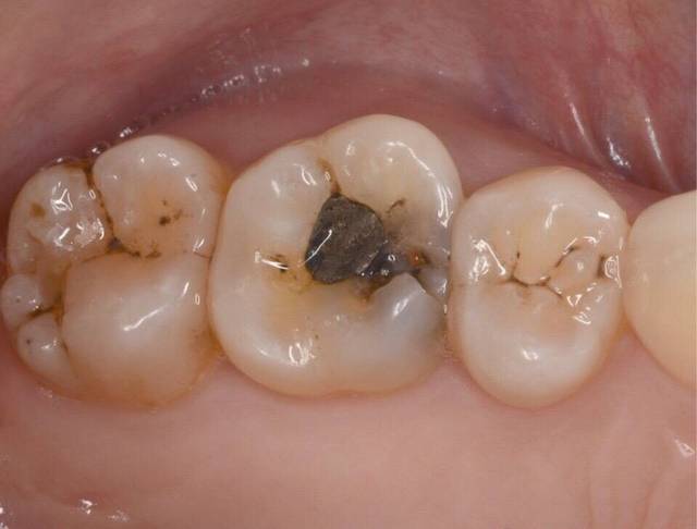2,银汞充填体和牙齿窝洞之间的微渗漏较大,比较容易出现继发龋坏