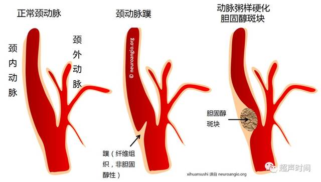 颈动脉股动脉的位置图图片