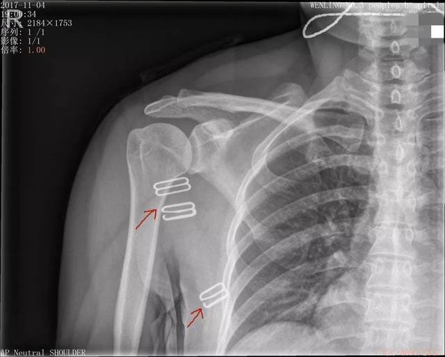 肩锁关节x光正常图图片