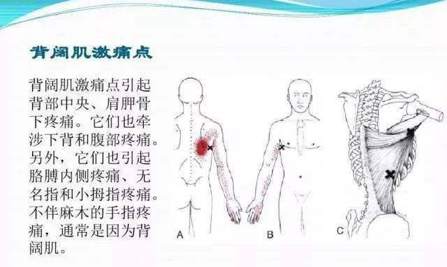 【疼痛科】有一种伤不起的痛,叫肌筋膜炎