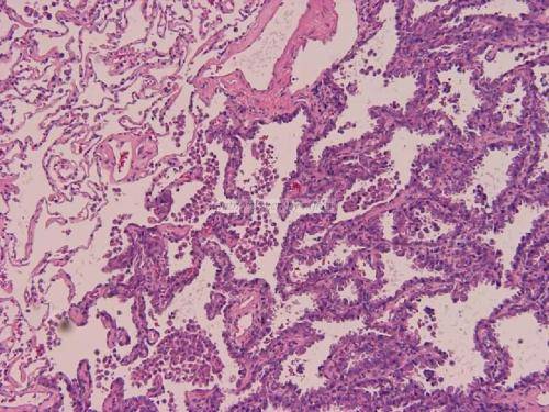 肺腺癌的病理学特征有哪些