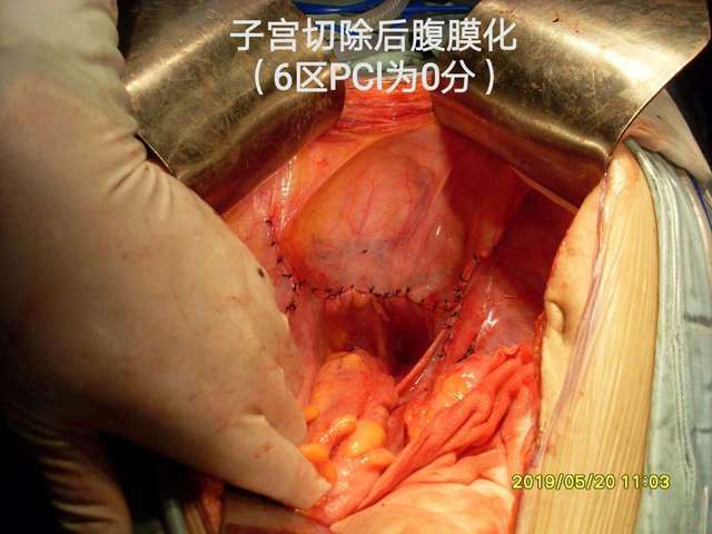 子宫切除后盆腔内部图图片
