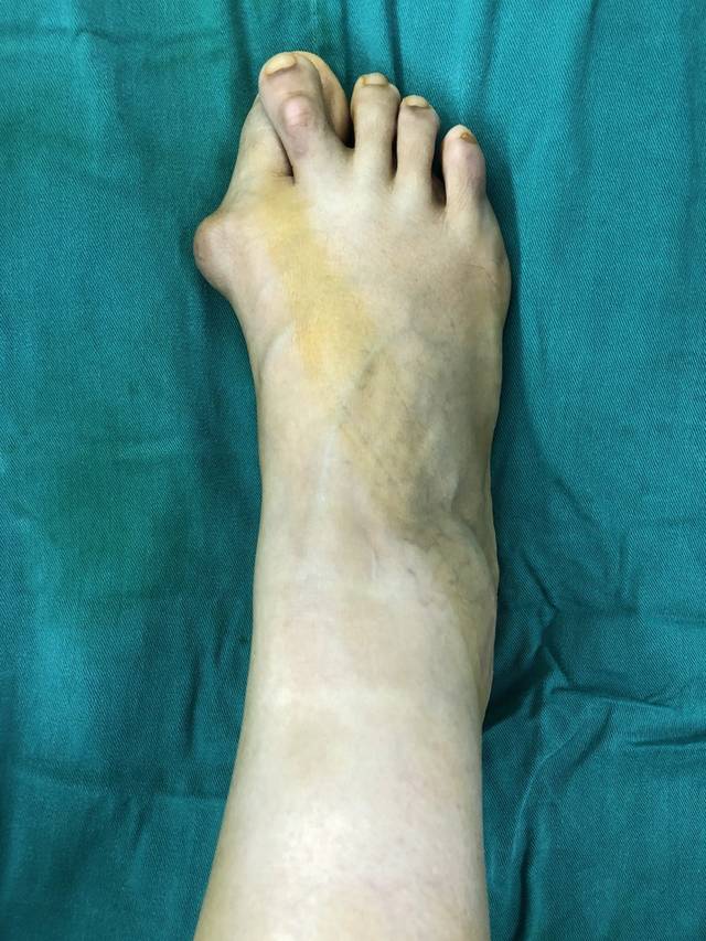 拇外翻交叉足趾矫形术 (原创)