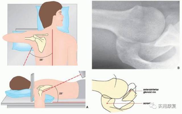 肩关节体位图片