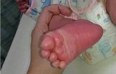 发烧3天错认感冒!罕见川崎病,出现这3个征兆赶快就医