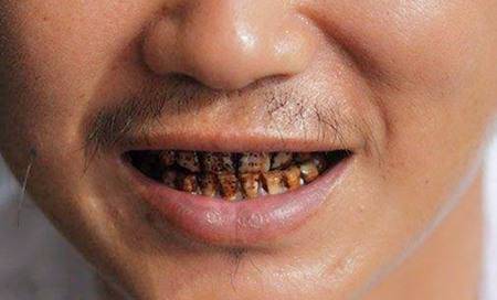 地下水含氟量过高怎么处理?