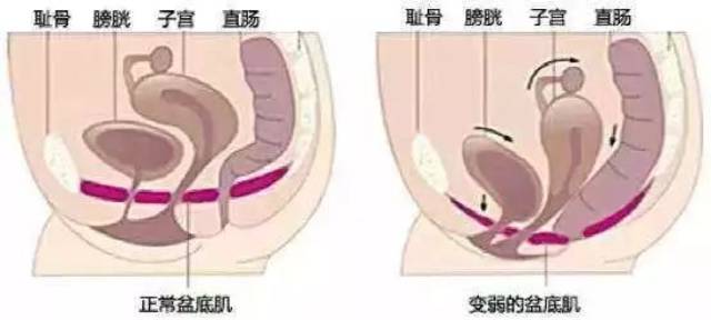 盆底肌修复
