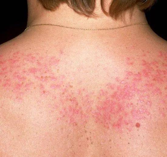 他描述了一种皮疹状况,极可能就是红斑狼疮导致的皮肤病变