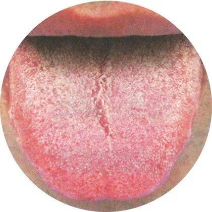 舌质红,有糙苔