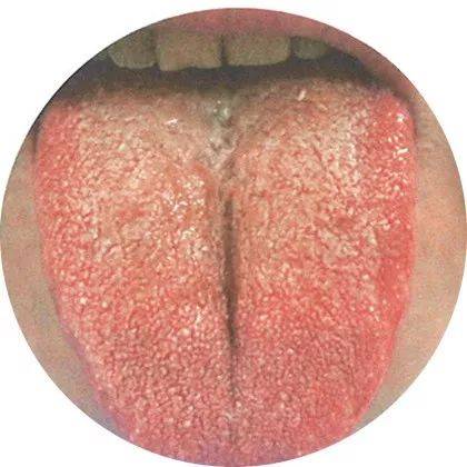 舌质:略微暗淡 舌质:薄腻,微黄 舌色:暗红色 此舌象患者或有手足冰凉