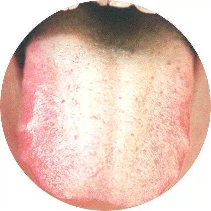 最全的舌诊图谱