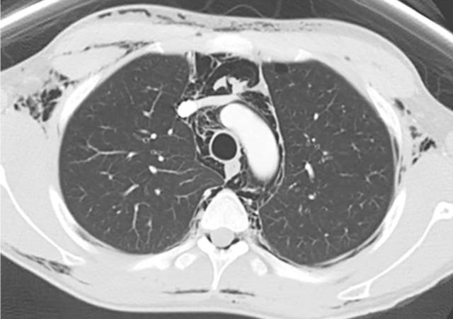 胸片显示广泛皮下气肿