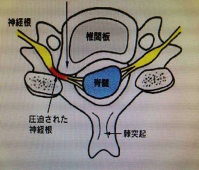 容易引起頸椎骨質增生,而轉變為神經根病變的因素之一,在椎間孔部lusc