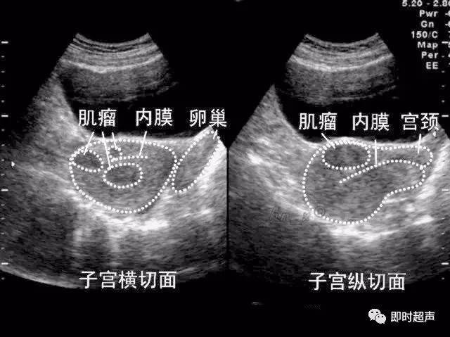 子宫肌瘤超声图像图片