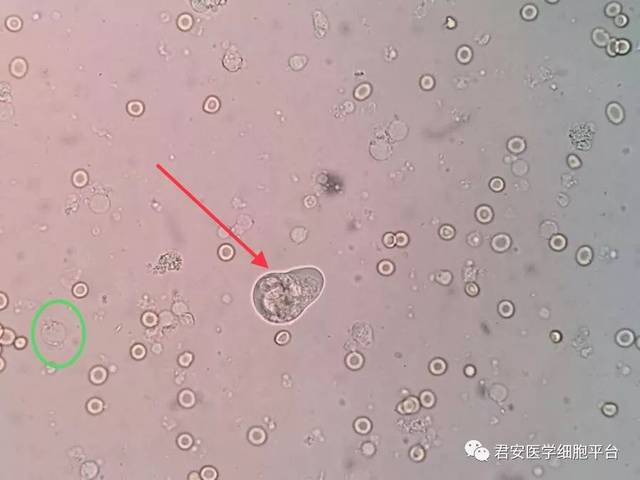红箭头:结肠内阿米巴滋养体;绿圈:人芽囊原虫