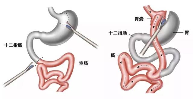 胃手术方式图解图片