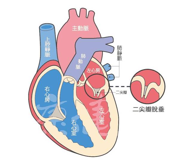 二尖瓣瓣叶分区图片