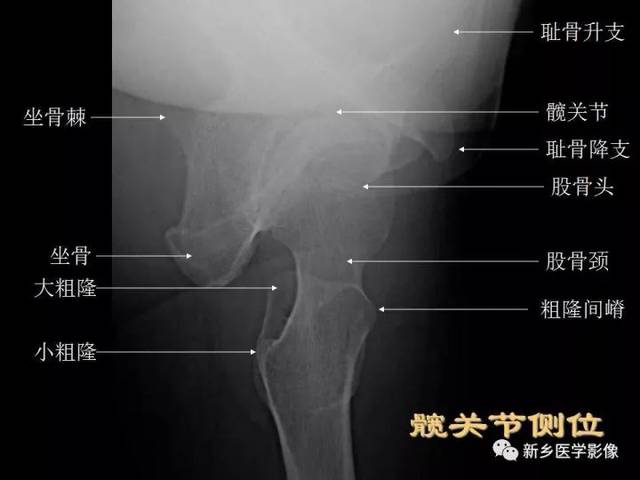 髋关节正位片上,股骨颈的长轴与股骨干纵轴之间形成的角度称为颈干角