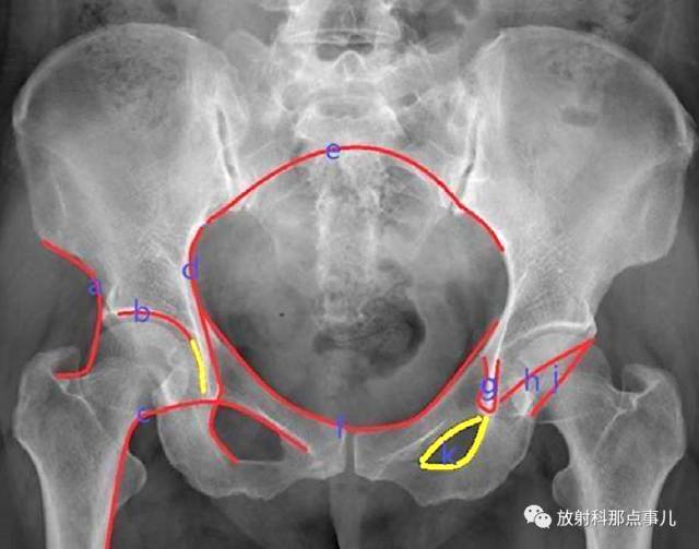 股骨x线解剖图片