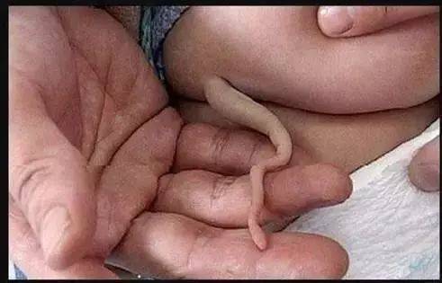 儿童肛门静脉曲张图片图片