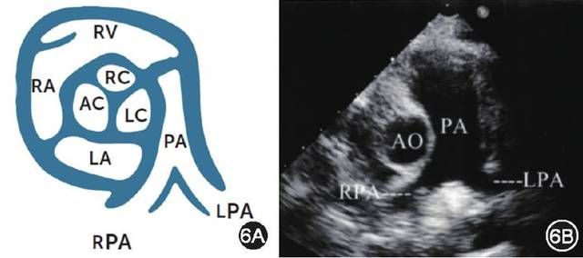关闭不全,ebstein畸形,三尖瓣闭锁),功能,测量三尖瓣反流压差等