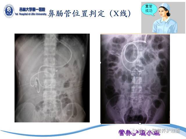 鼻空肠管X线图片