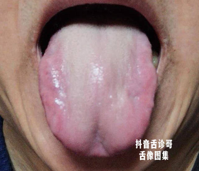 胆结石舌苔图片图片