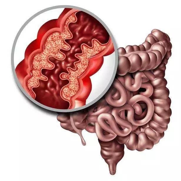 主要包括潰瘍性結腸炎(ulcerative colitis,uc)和克羅恩病(crohns