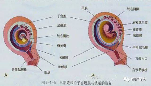 sch)是发生在先兆流产,先兆早产时子宫腔内胎膜与包蜕膜之间的血肿