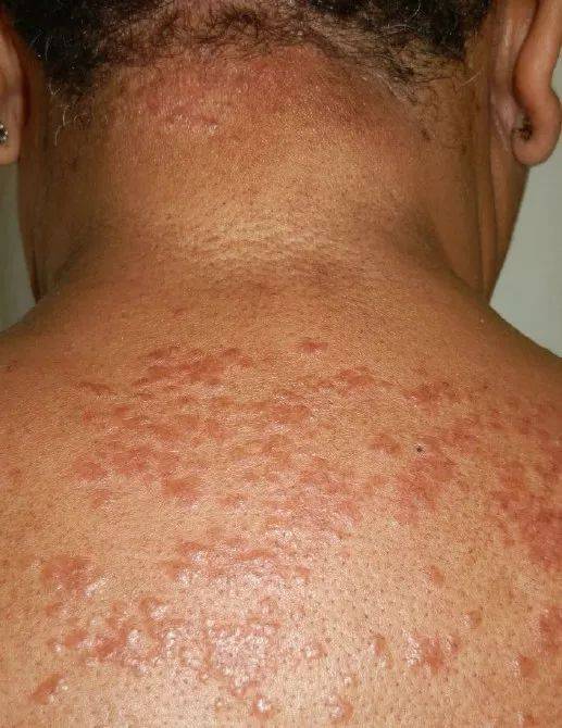 今日病例:头皮结节病_手机搜狐网