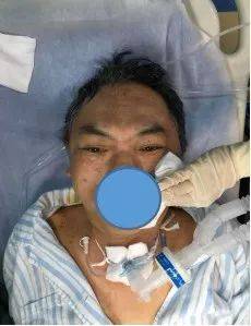 渐冻人全麻气管插管下行气管切开术一例