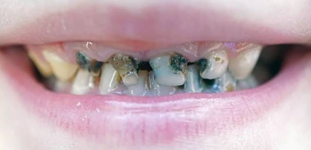 儿童乳牙龋患率不断飙升:保护孩子的牙齿健康,需要做到这3点