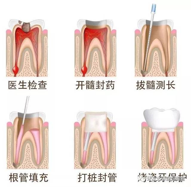 前牙根管治疗步骤图解图片