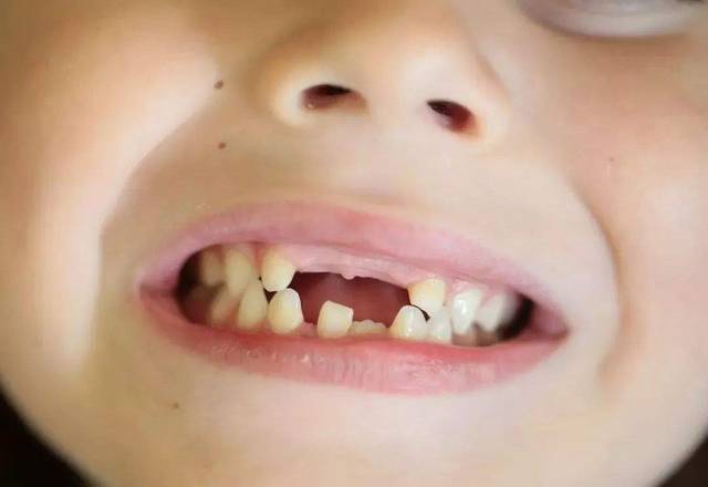 牙齿畸形是小问题?孩子的自卑感也由此而来啊