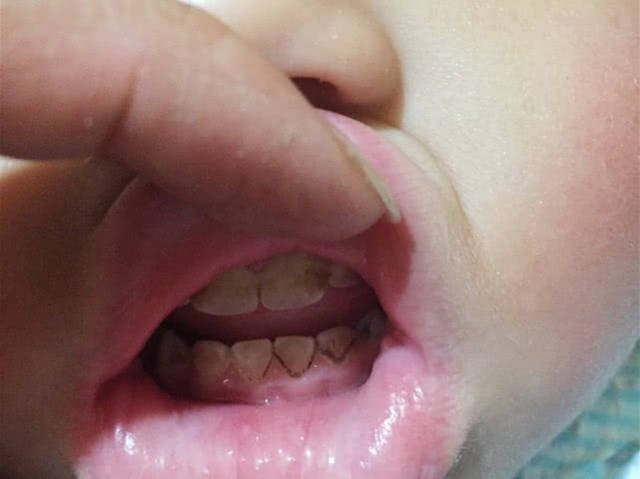 19个月男孩牙齿变黄,听到医生检查后说出的话,奶奶不好意思了
