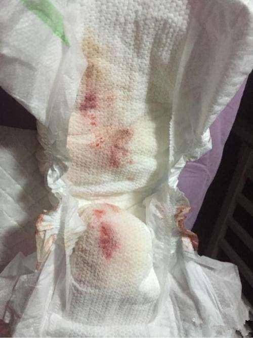 新生儿假月经怎么辨别