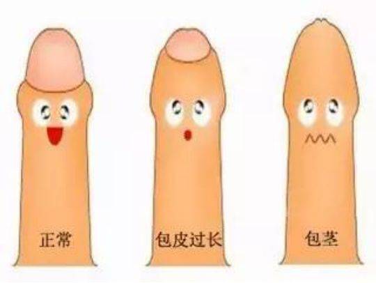 包皮过长不够凉爽?悄悄告诉你小丁丁的那点事儿