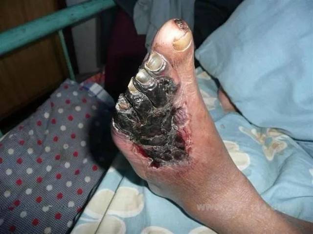 直播预告从血糖高到糖尿病足您离这个可导致截肢的恐怖并发症到底有