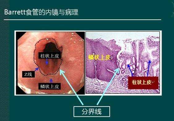 巴雷特食管图片怎么看图片