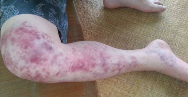 身体各部位拍痧方法(六)四肢