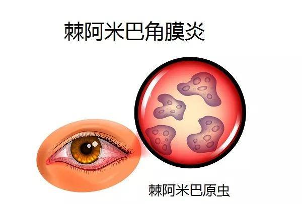 英国一男子因长期戴隐形眼镜洗澡,竟导致右眼失明,病状让人触目惊心!