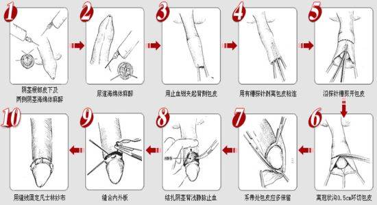 2,袖套式切除法