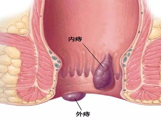 东昌府区中医院肛肠科为您讲解常见的肛肠疾病_手机搜狐网