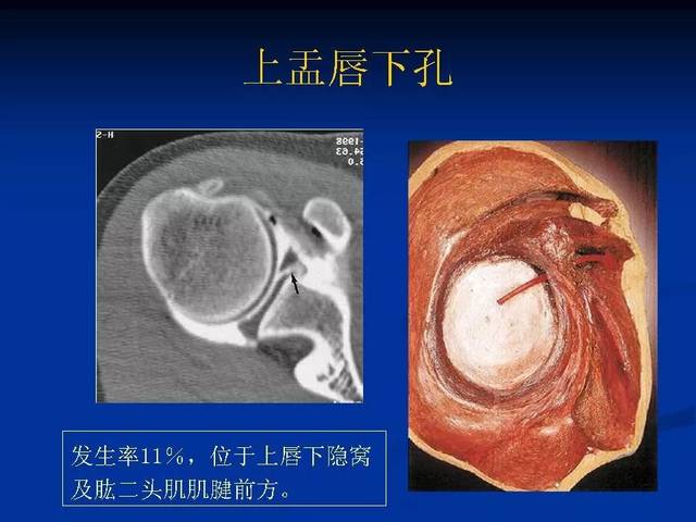 盂唇解剖位置图片