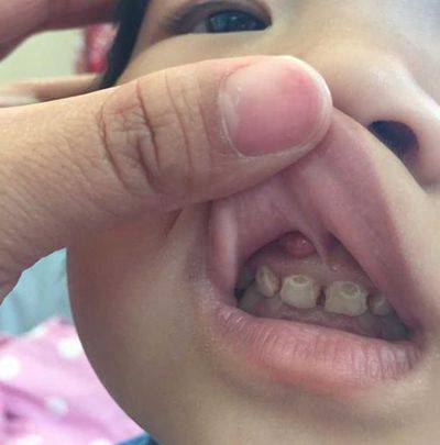 儿牙专栏 ! 宝宝牙齿外伤,牙龈脓包问题解答
