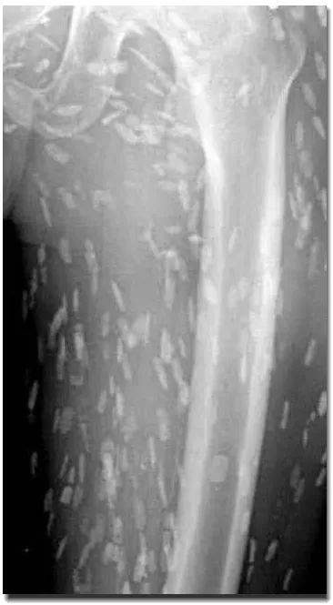 这是李教授查阅的文献当中一个成年人的大腿,肌肉中密密麻麻都是钙化