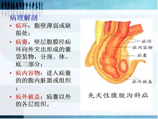 腹外疝结构示意图图片