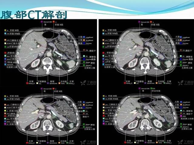 十二指肠旁疝的影像学表现(点击原文可查看直播)