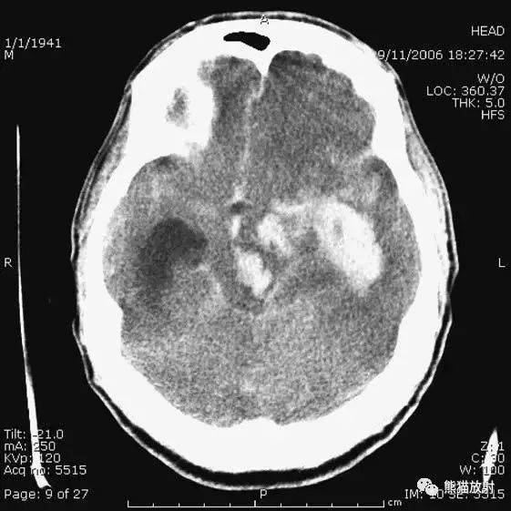 簡明又詳細的頭部ct讀片詳解,收藏!
